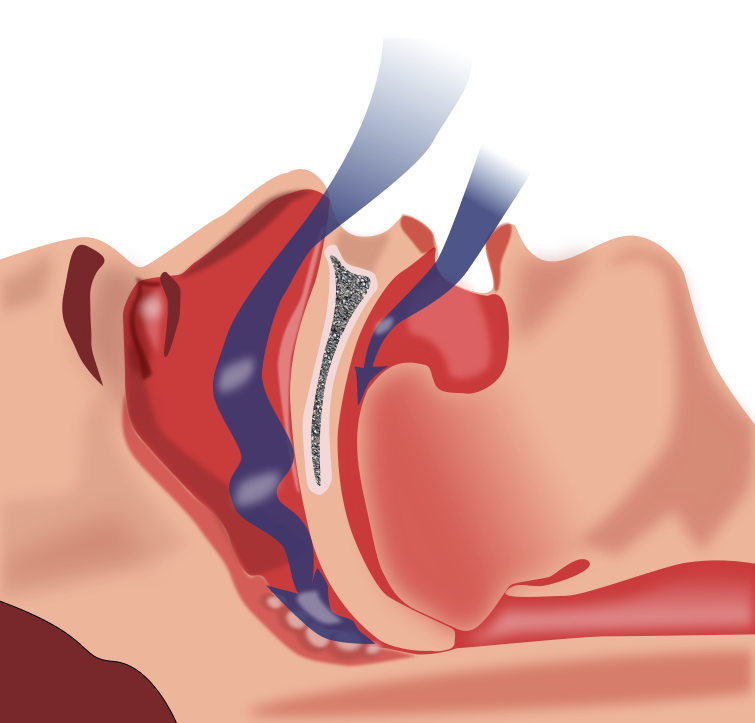 755px-Obstruction_ventilation_apne_sommeil.svg