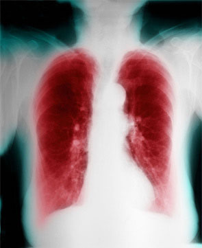 AECOPD