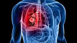 Lung.cancer