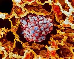 NSCLC3