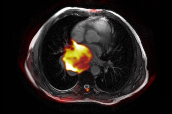 PETSCAN