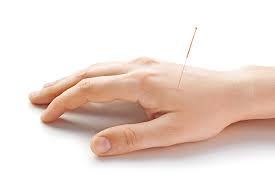 acupuncture