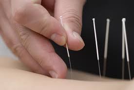 acupuncture_