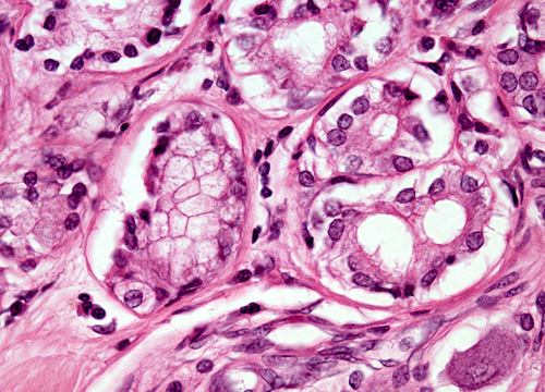 adenocarcinomaoflung40x01