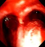 bleeding