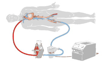 ecmo