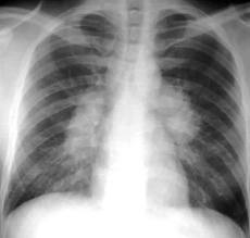 sarcoidosis